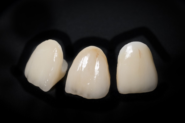 ceramic crowns